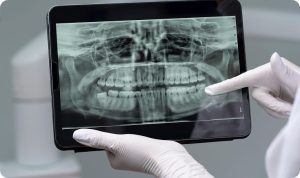 complex implantation